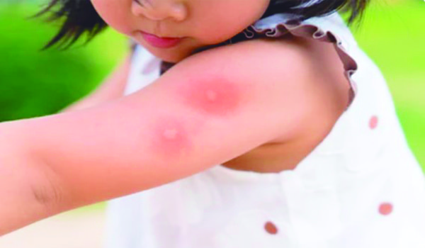 Proteger a los niños de las plagas
